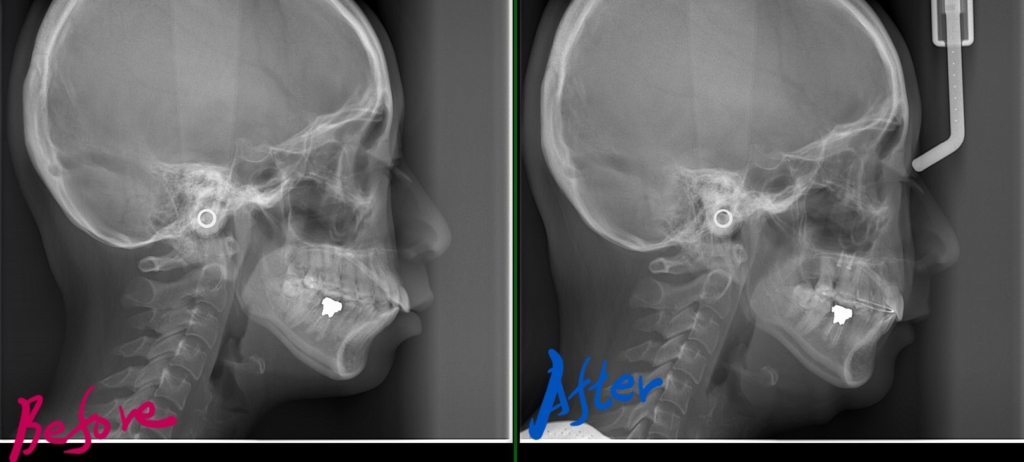口ゴボを矯正した治療前後のレントゲン写真による比較