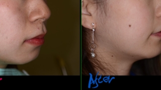 口ゴボを矯正した治療前後の横顔と口元の変化の比較