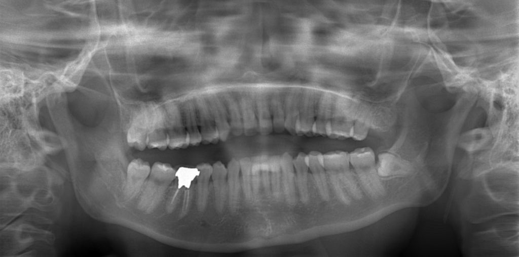 ゴボ口の矯正前の顎全体のレントゲン写真