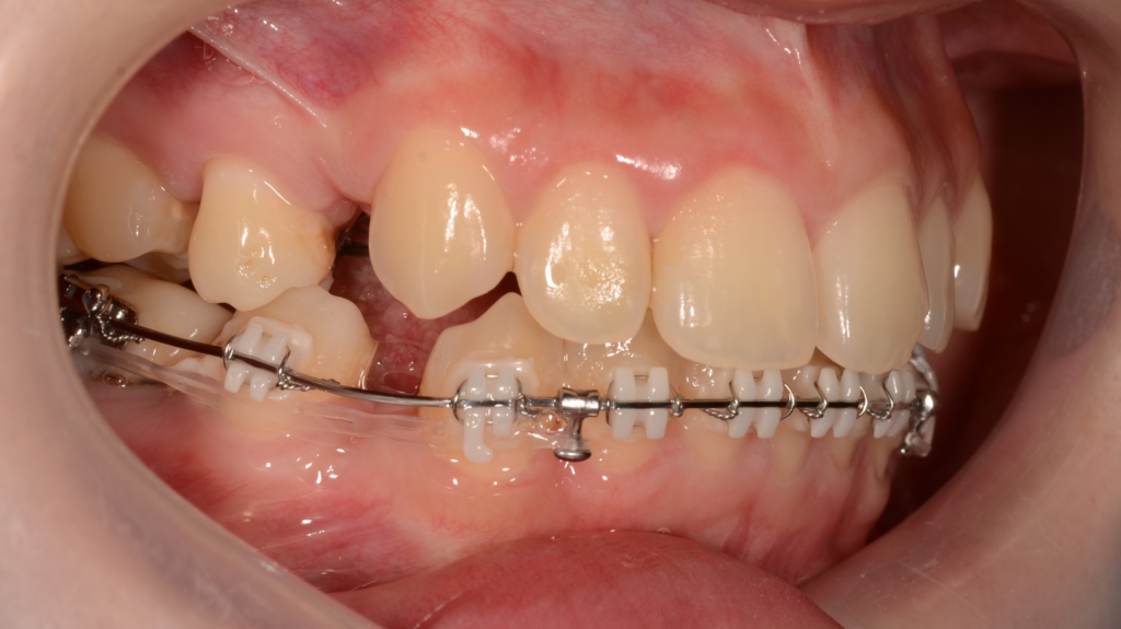 アンカースクリューを併用した矯正治療（ハーフリンガル）