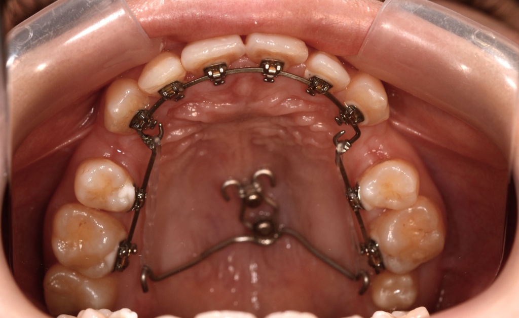 アンカースクリューを併用した矯正治療（ハーフリンガル）