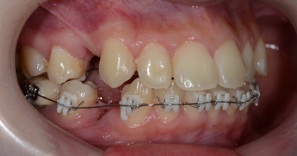 ハーフリンガルによるマルチブラケットシステムで矯正治療開始