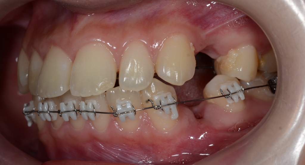 ハーフリンガルによるマルチブラケットシステムで矯正治療開始