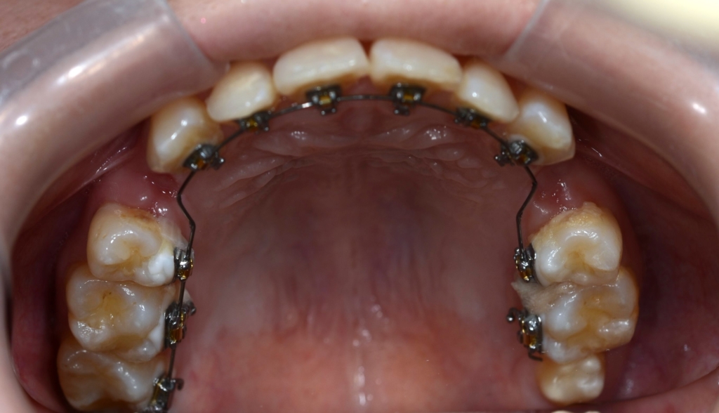 ハーフリンガルによるマルチブラケットシステムで矯正治療開始