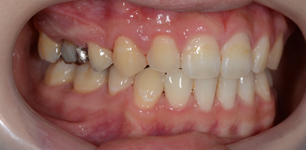 ガミースマイルでゴボ口を矯正した後の歯並び