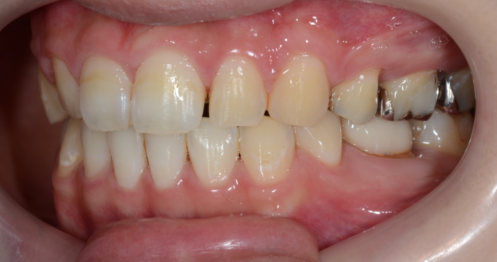 ガミースマイルでゴボ口を矯正した後の歯並び