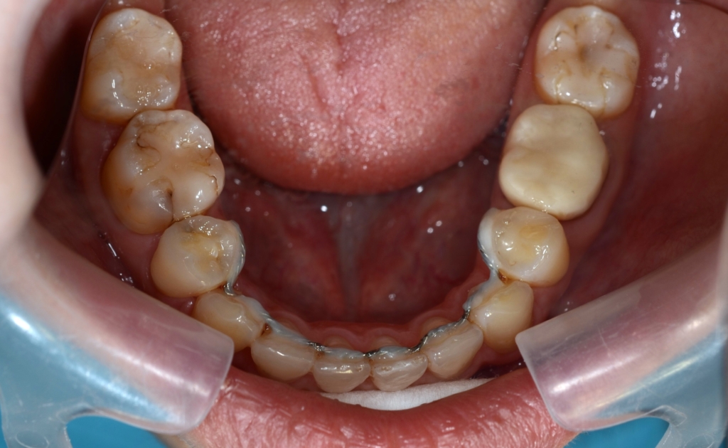 ガミースマイルでゴボ口を矯正した後の歯並び