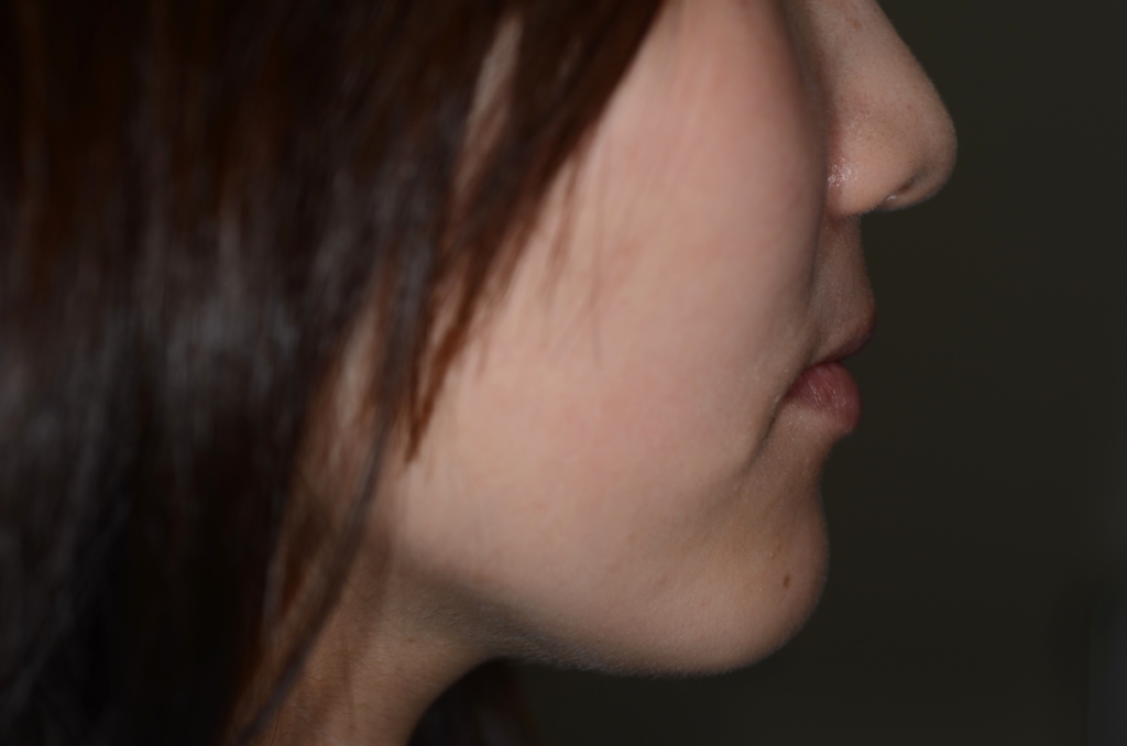 ガミースマイルでゴボ口を矯正した後の横顔と口元