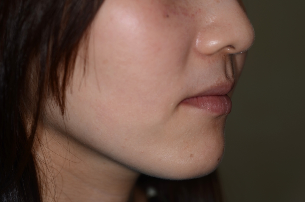 ガミースマイルでゴボ口を矯正した後の横顔と口元