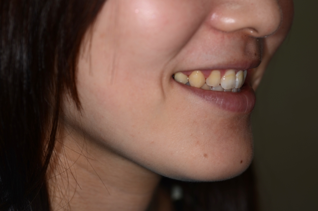 ガミースマイルでゴボ口を矯正した後の横顔と口元（笑顔）