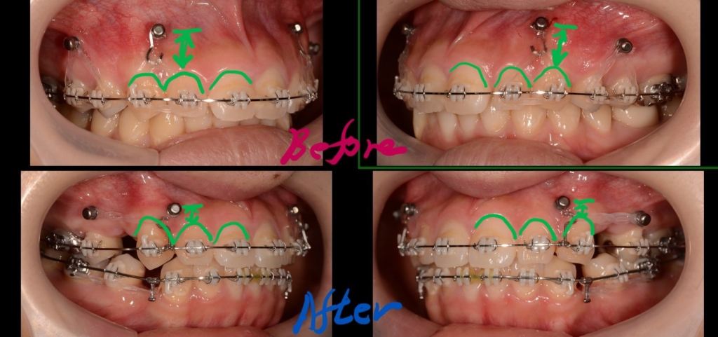 ガミースマイルの改善に伴う、アンカースクリュー下方に広がる歯肉の範囲の変化
