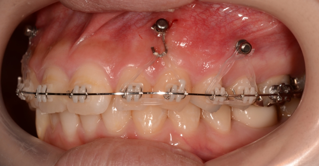 アンカースクリューを用いて上の歯列全体を圧下させて、ガミースマイルの改善を図る