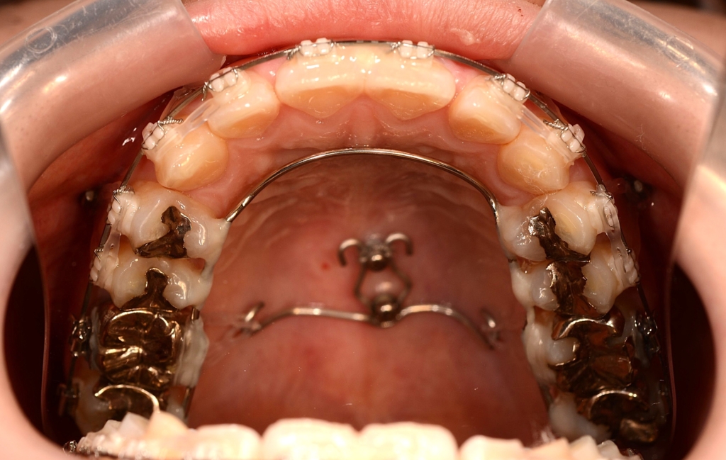 アンカースクリューを用いて上の歯列全体を圧下させて、ガミースマイルの改善を図る