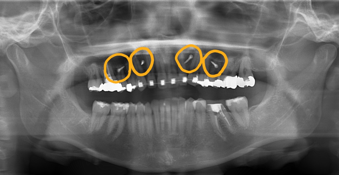 上顎の前歯部と臼歯部の頬側にアンカースクリューを植立