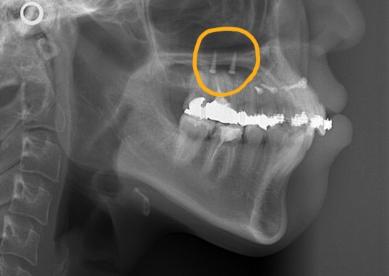 上顎の口蓋にアンカースクリューを植立