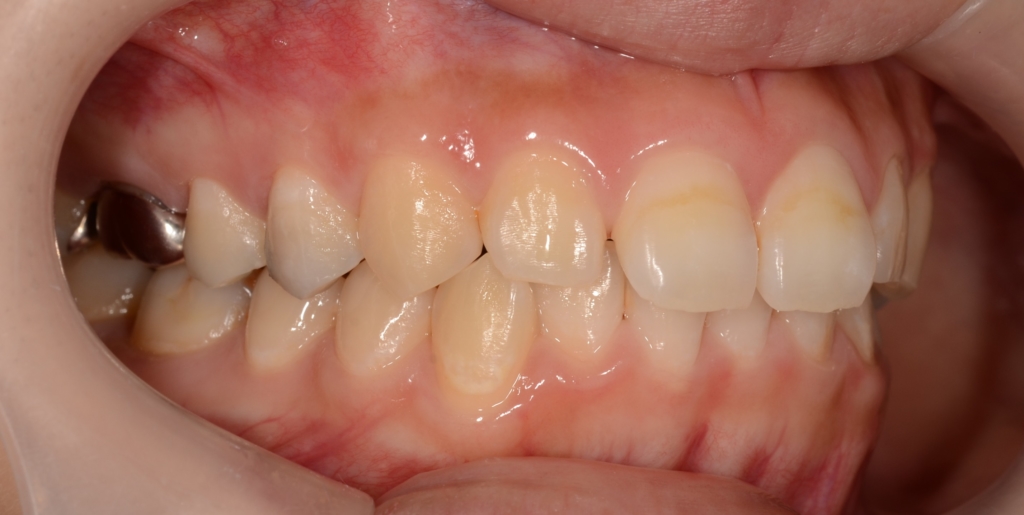 ガミースマイルでゴボ口を矯正する前の歯並び