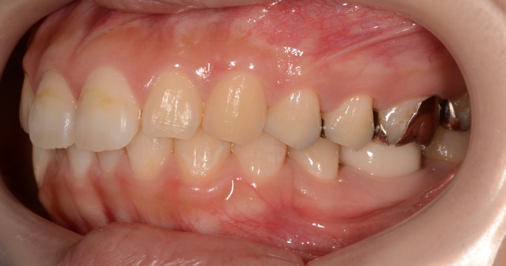 ガミースマイルでゴボ口を矯正する前の歯並び