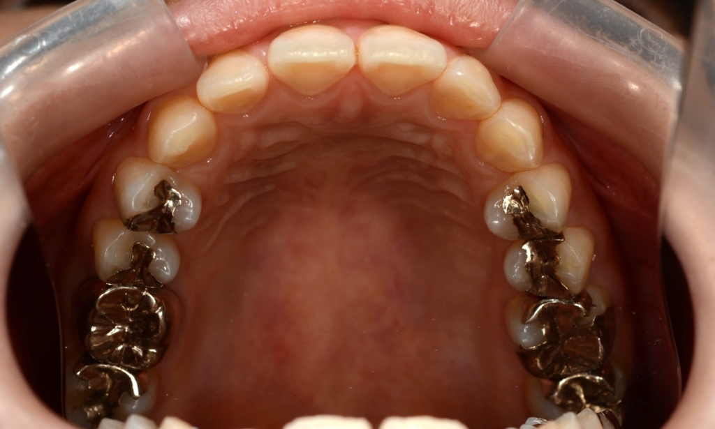 ガミースマイルでゴボ口を矯正する前の歯並び