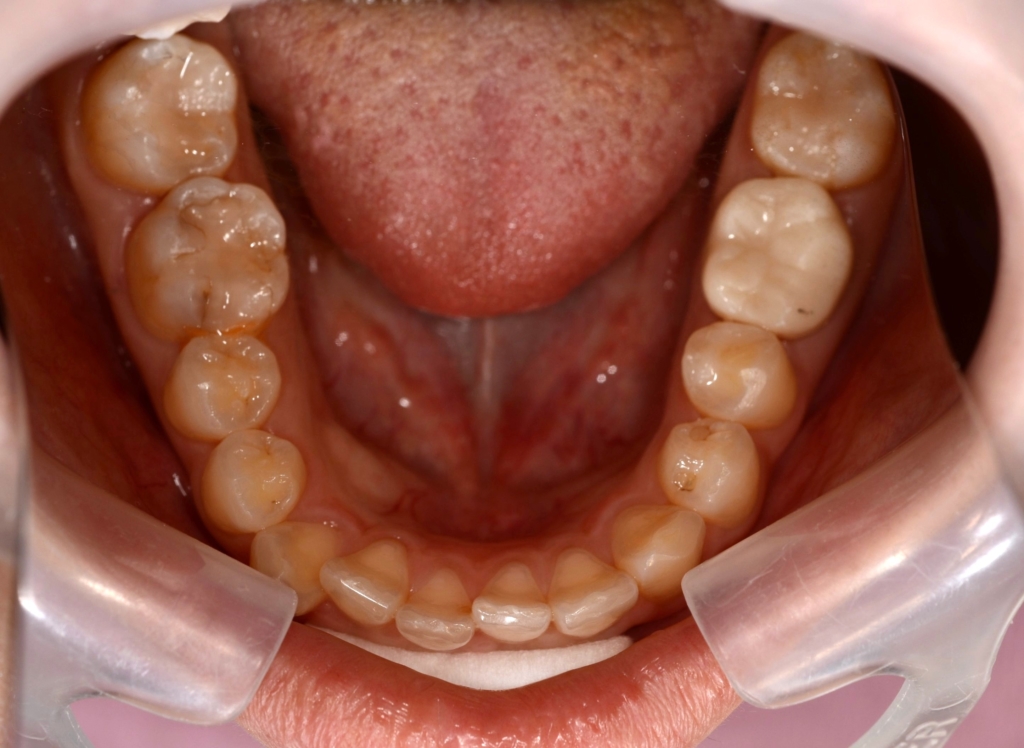 ガミースマイルでゴボ口を矯正する前の歯並び