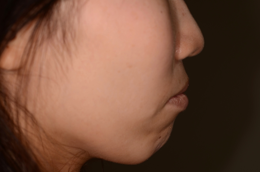 ガミースマイルでゴボ口を矯正する前の横顔と口元