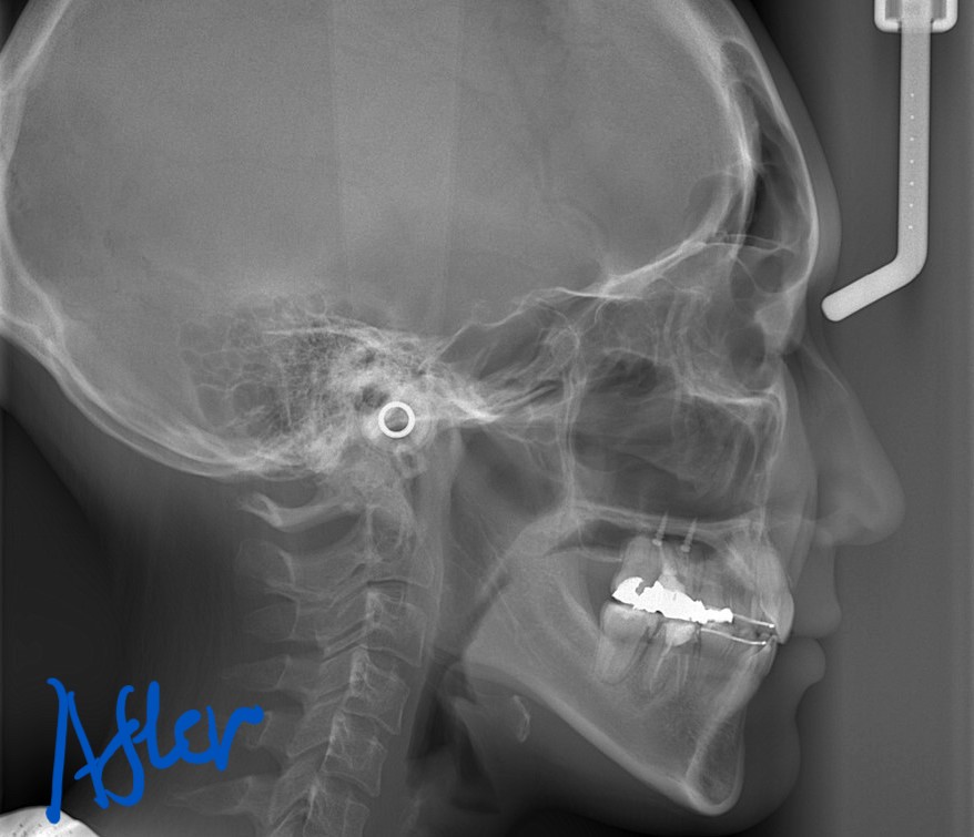 ガミースマイルでゴボ口の矯正後の頭部を横から見たレントゲン写真