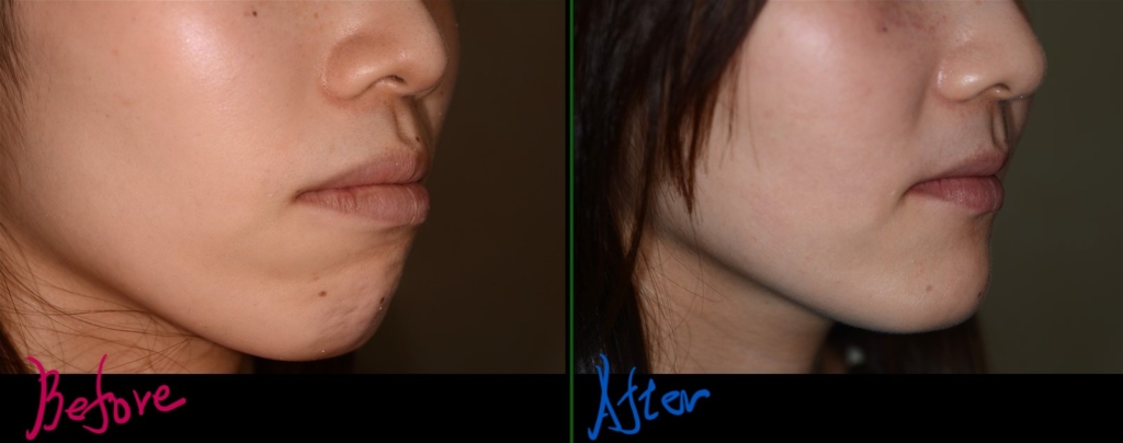 ガミースマイルでゴボ口を矯正した治療前後の横顔と口元の比較