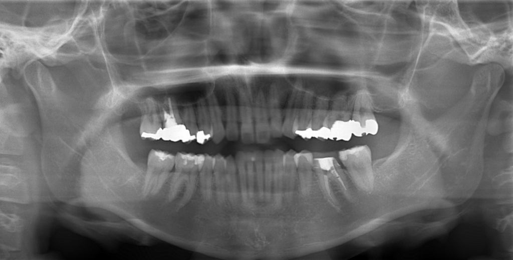 ガミースマイルでゴボ口の矯正前の顎全体のレントゲン写真
