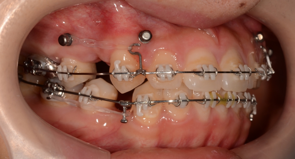 アンカースクリューも併用しながら、前歯部を引っ込めている治療途中