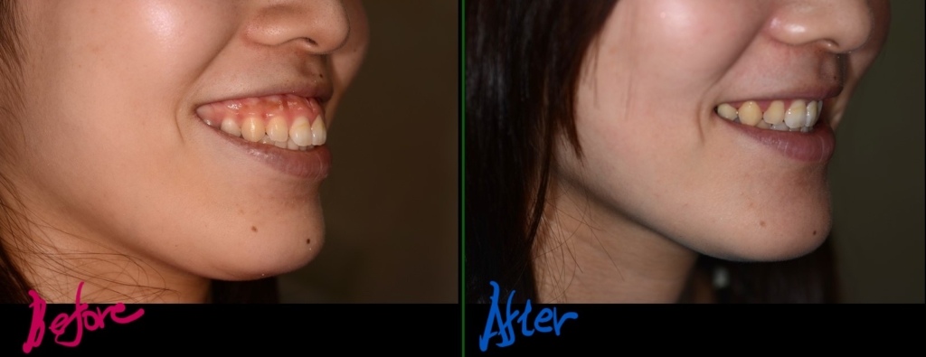 ガミースマイルでゴボ口を矯正した治療前後の横顔と口元（笑顔）の比較