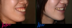 ガミースマイルでゴボ口を矯正した治療前後の横顔と口元（笑顔）の比較