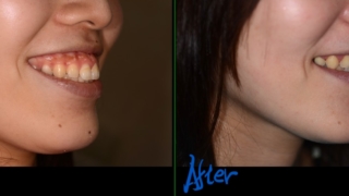 ガミースマイルでゴボ口を矯正した治療前後の横顔と口元（笑顔）の比較
