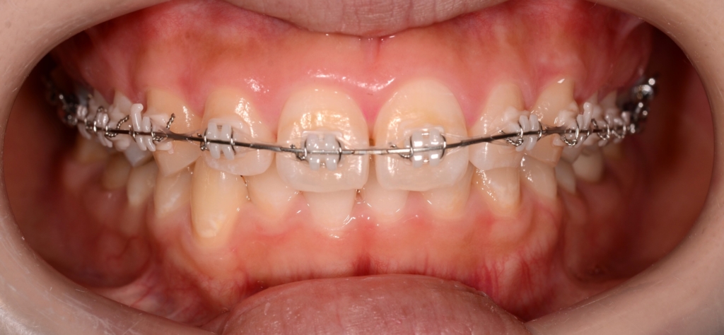 マルチブラケットシステムで矯正治療開始（取り急ぎしばらくは上顎のみ）