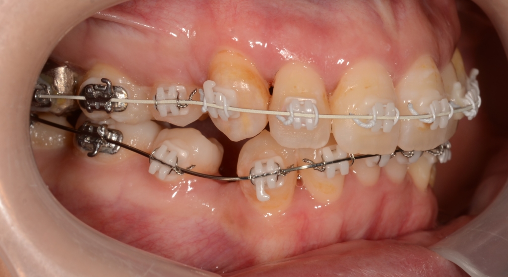 マルチブラケットシステム(白いワイヤー使用)で矯正治療中(約6か月経過