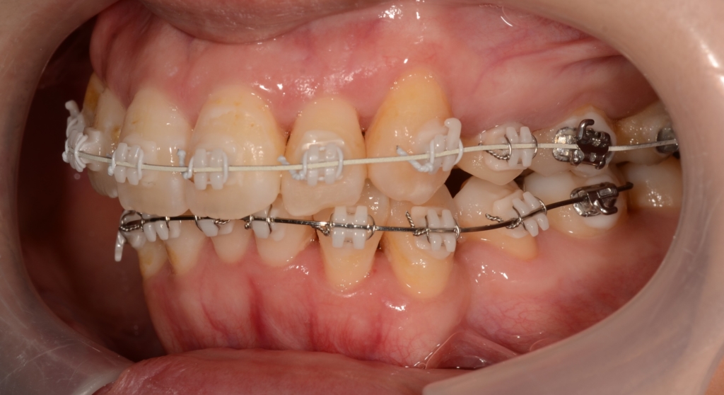 マルチブラケットシステム(白いワイヤー使用)で矯正治療中(約6か月経過