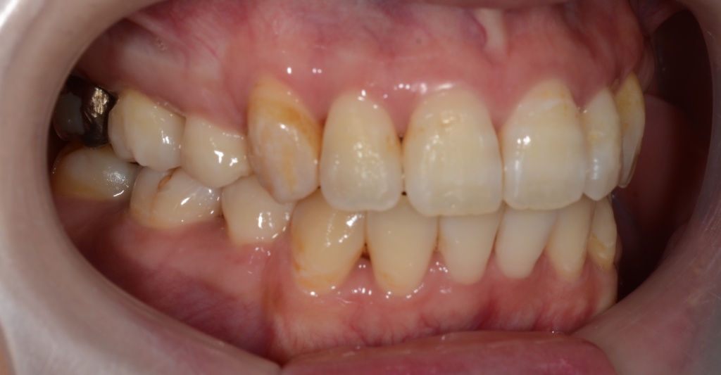 叢生(デコボコ)を矯正した後の歯並び