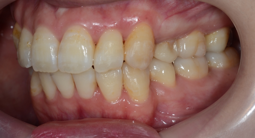 叢生(デコボコ)を矯正した後の歯並び