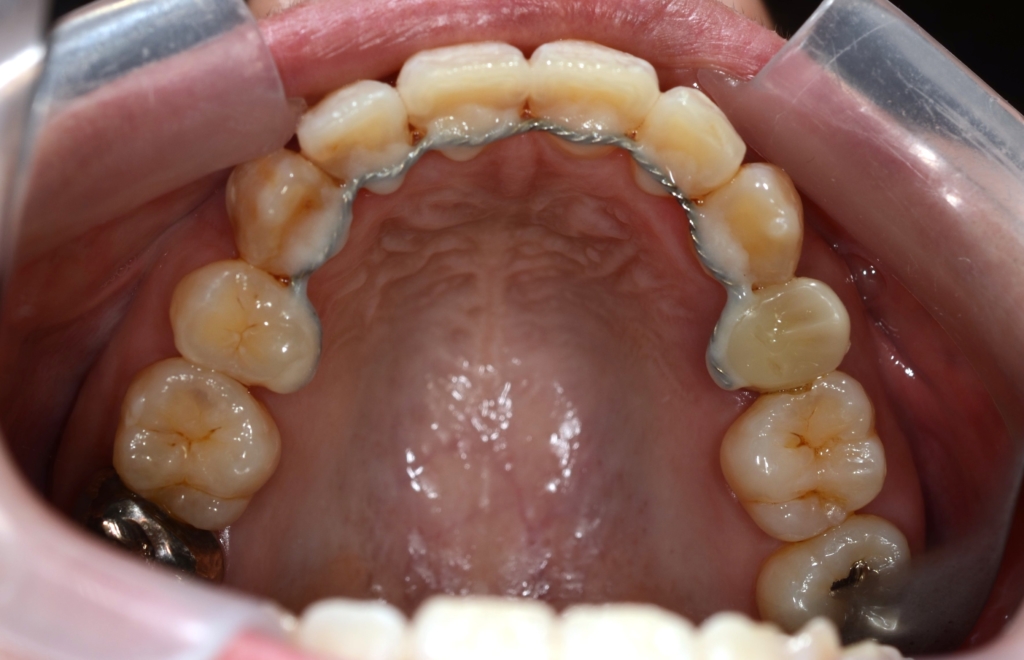 叢生(デコボコ)を矯正した後の歯並び