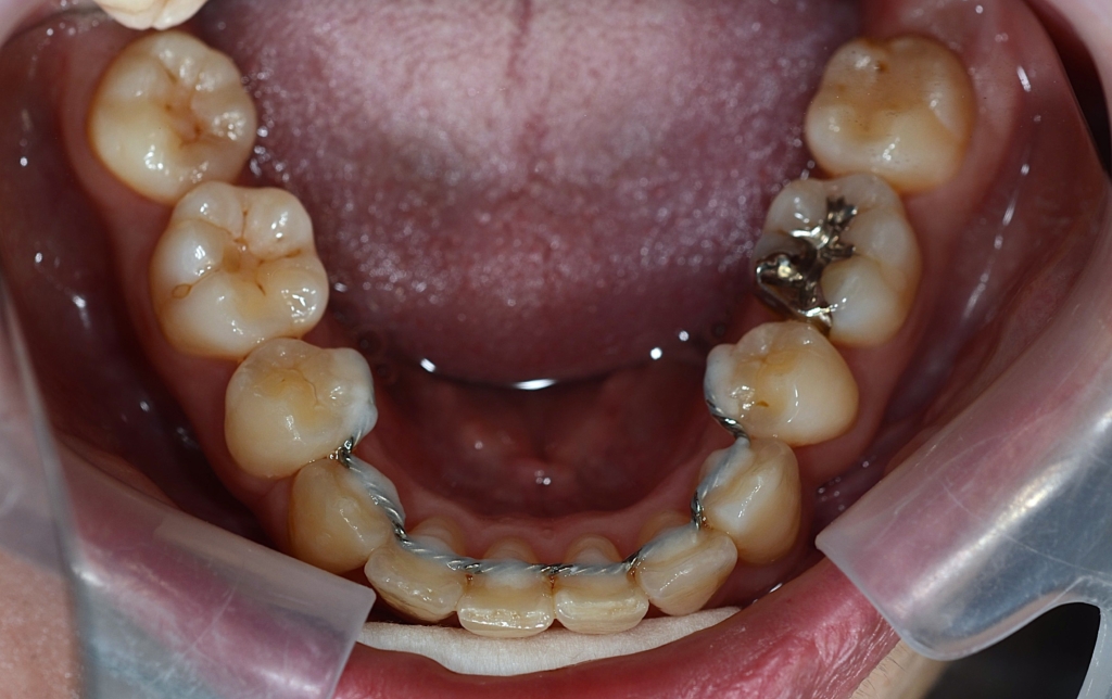 叢生(デコボコ)を矯正した後の歯並び