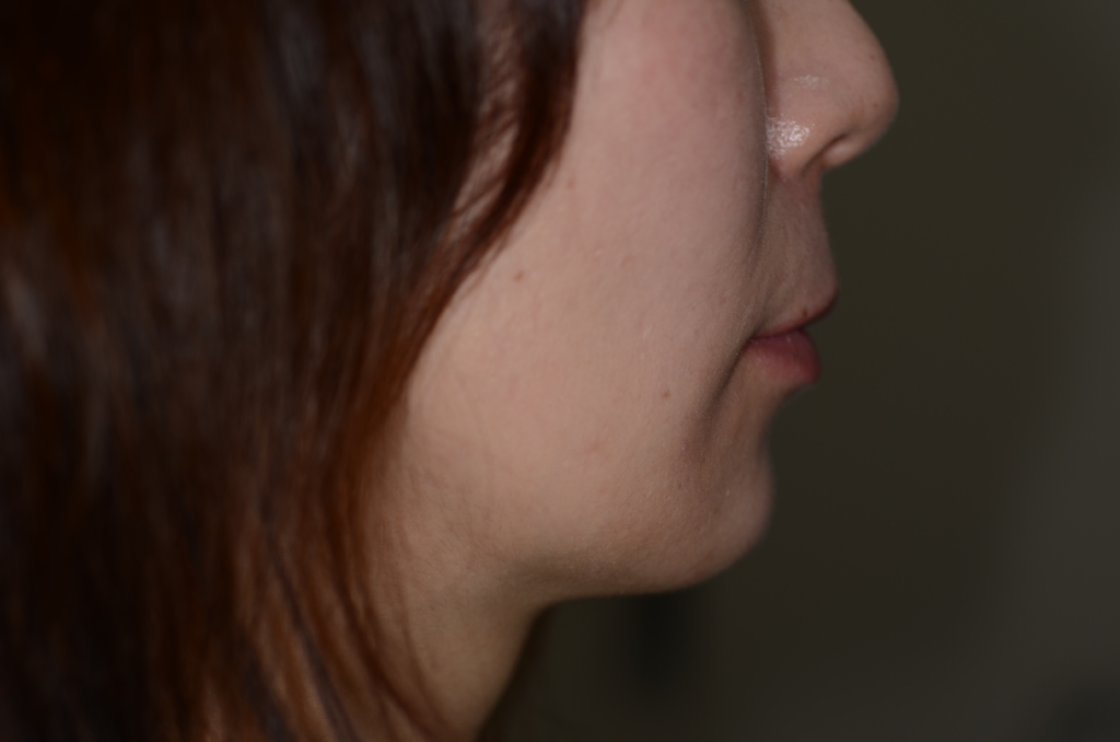 叢生(デコボコ)を矯正した後の横顔と口元