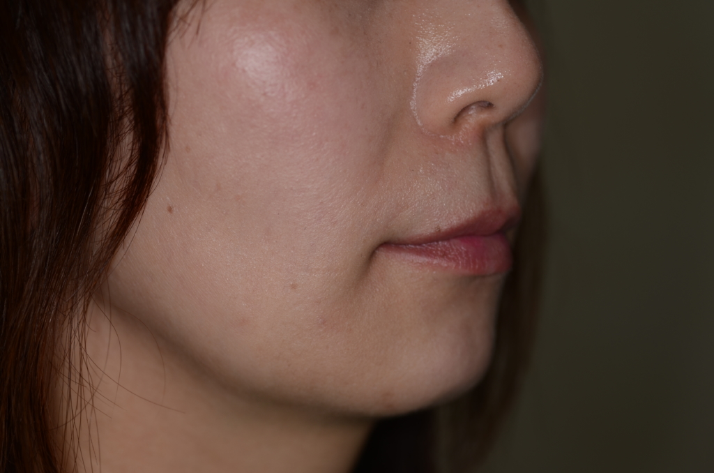 叢生(デコボコ)を矯正した後の横顔と口元