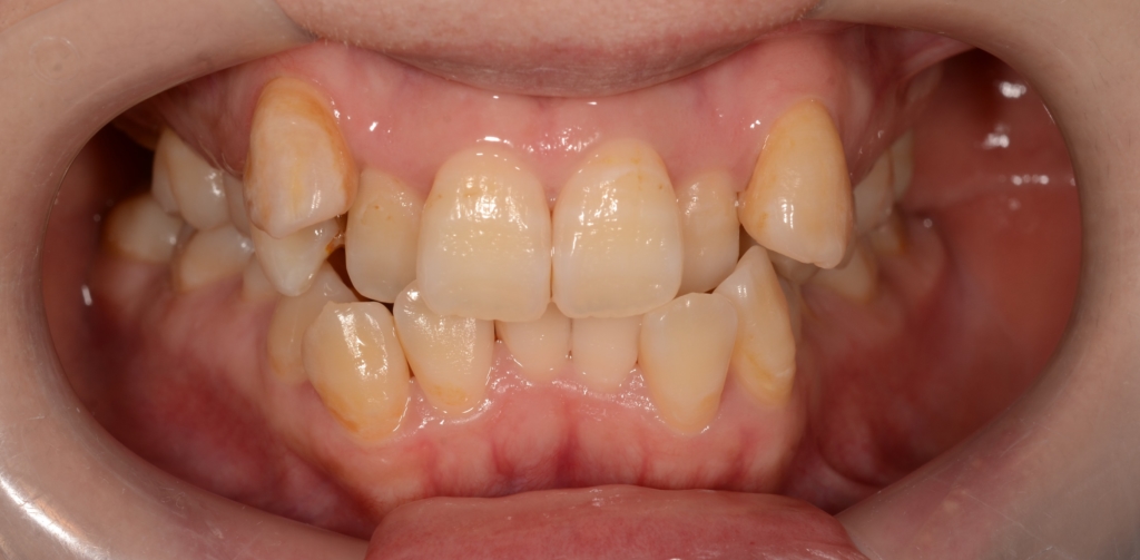 叢生(デコボコ)を矯正する前の歯並び