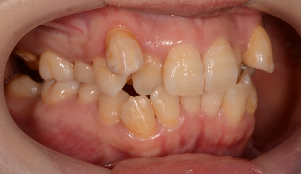 叢生(デコボコ)を矯正する前の歯並び