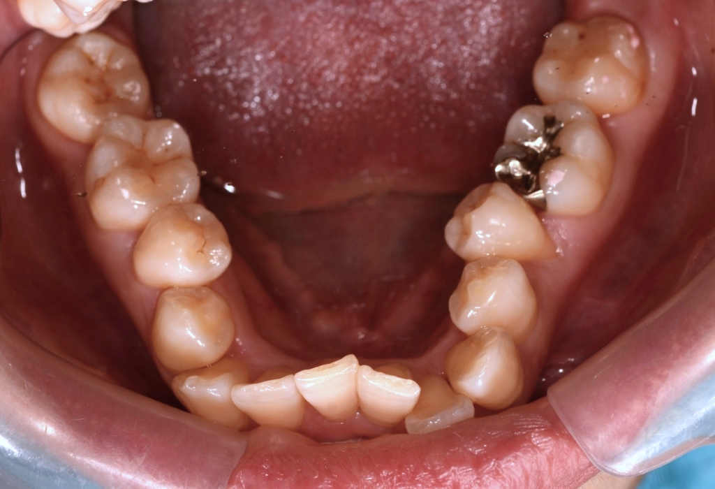 叢生(デコボコ)を矯正する前の歯並び