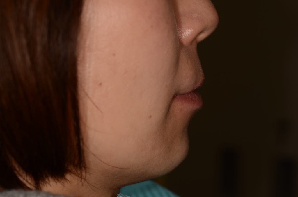 叢生(デコボコ)を矯正する前の横顔と口元
