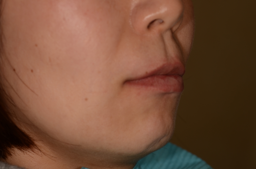 叢生(デコボコ)を矯正する前の横顔と口元