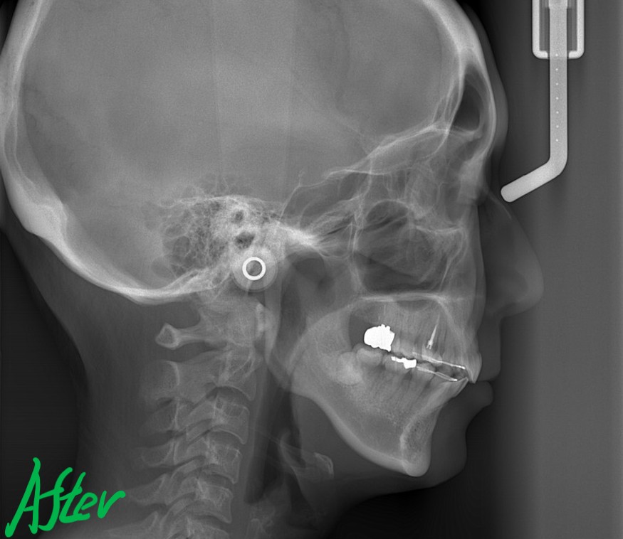 叢生(デコボコ)の矯正後の頭部を横から見たレントゲン写真