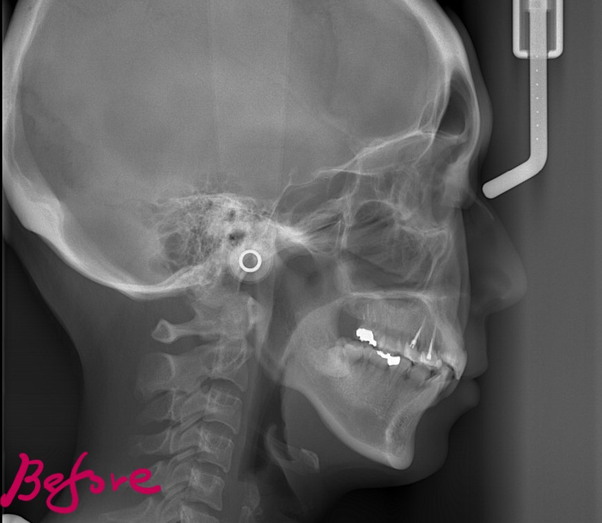 叢生(デコボコ)の矯正前の頭部を横から見たレントゲン写真