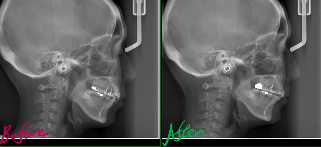 叢生を矯正した治療前後のレントゲン写真による比較