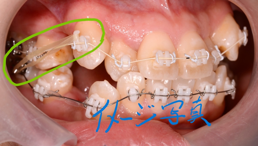 顎間ゴムを使用している状態(イメージ写真)