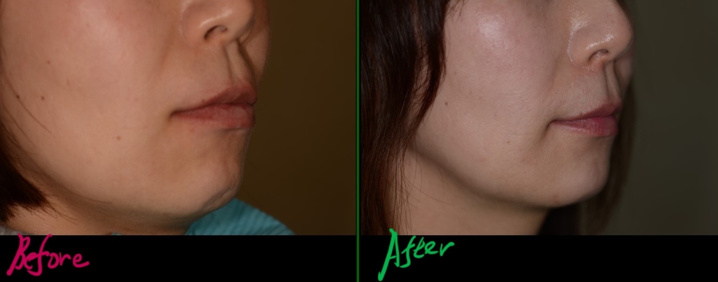 叢生を矯正した治療前後の横顔と口元の比較